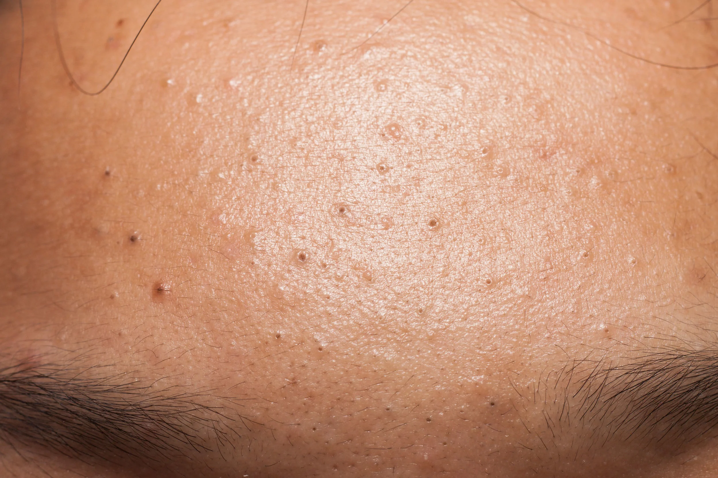 Blackheads and whiteheads (non-inflammatory)
