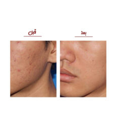 میکرودرم خانگی مدل MCOO4