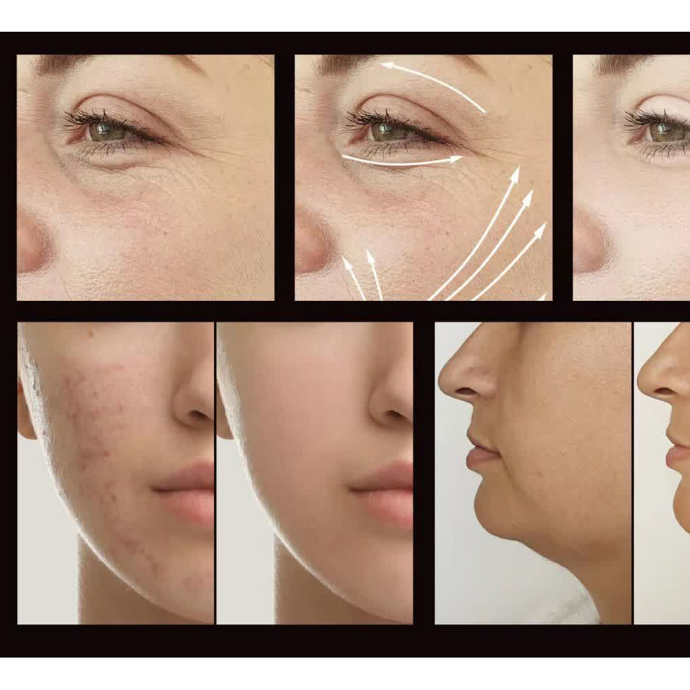 دستگاه جوانسازی هایفرکوئنسی مدل LZ-006A