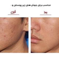 میکرودرم خانگی مدل CO