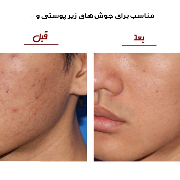میکرودرم خانگی مدل CO