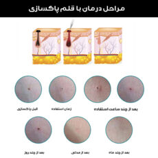 قلم پاک سازی پوست کد ZM-604